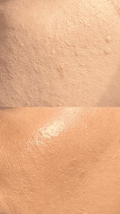 Microneedling Before & After Gallery - Patient 167725 - Image 1