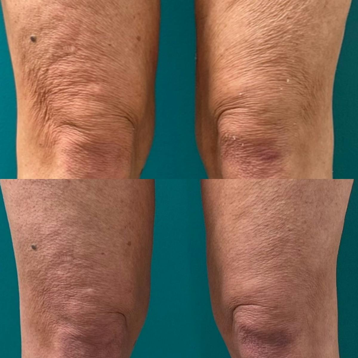 Thermage RF Before & After Gallery - Patient 193697 - Image 3