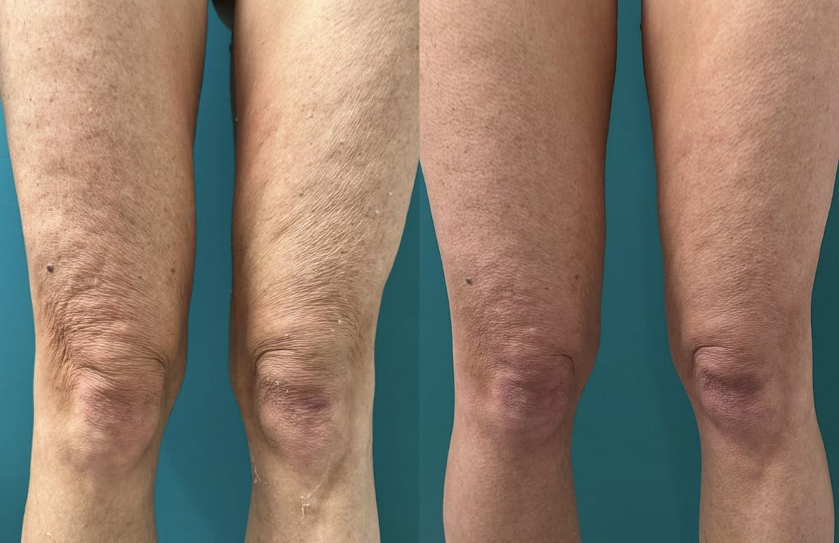 Thermage RF Before & After Gallery - Patient 193697 - Image 2
