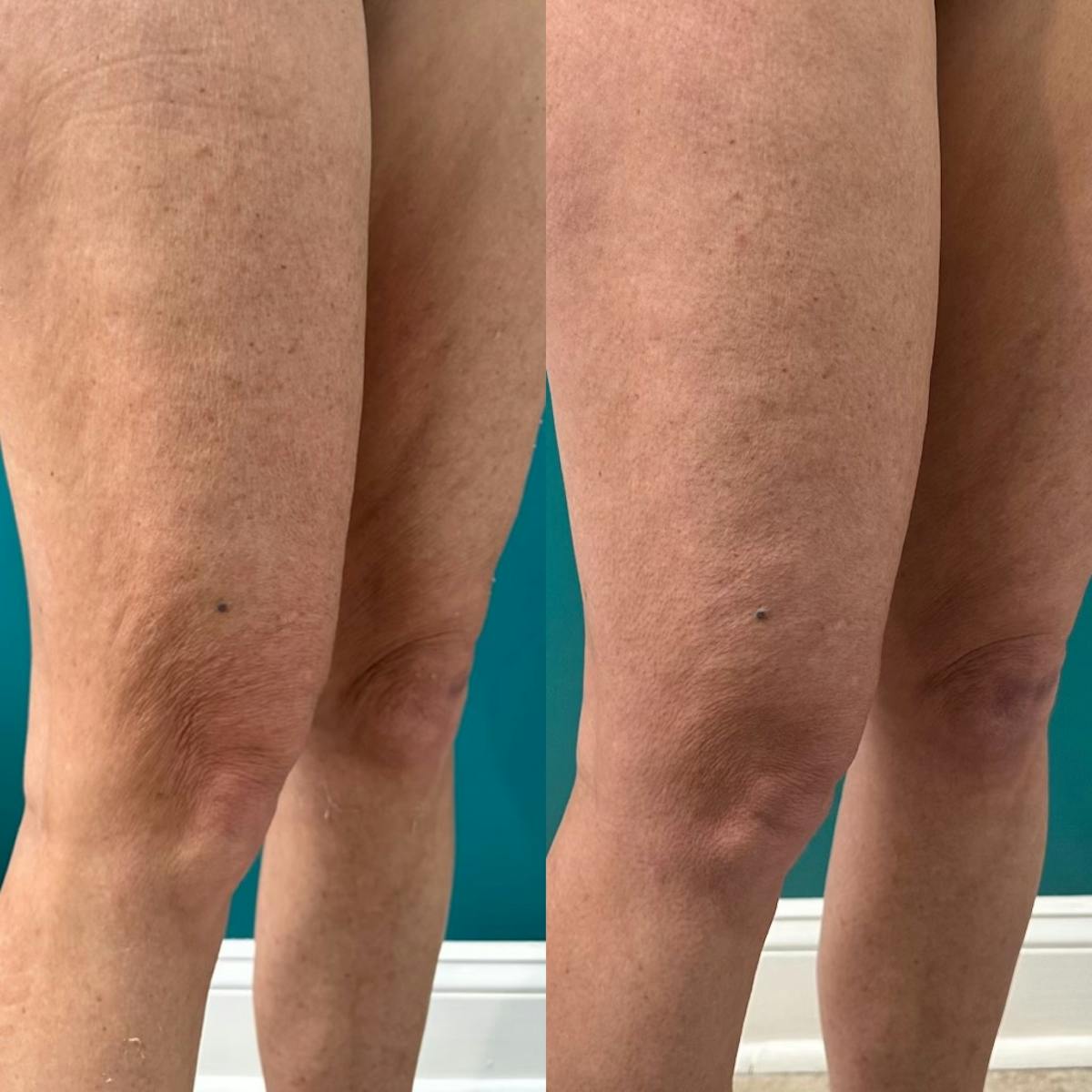 Thermage RF Before & After Gallery - Patient 193697 - Image 1