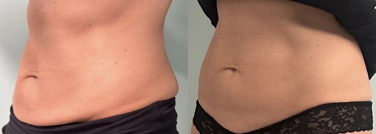 Thermage RF Before & After Gallery - Patient 250476 - Image 1