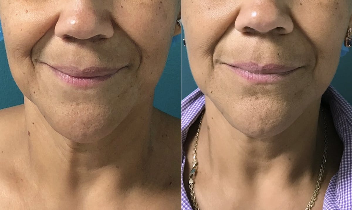 Thermage RF Before & After Gallery - Patient 866191 - Image 1