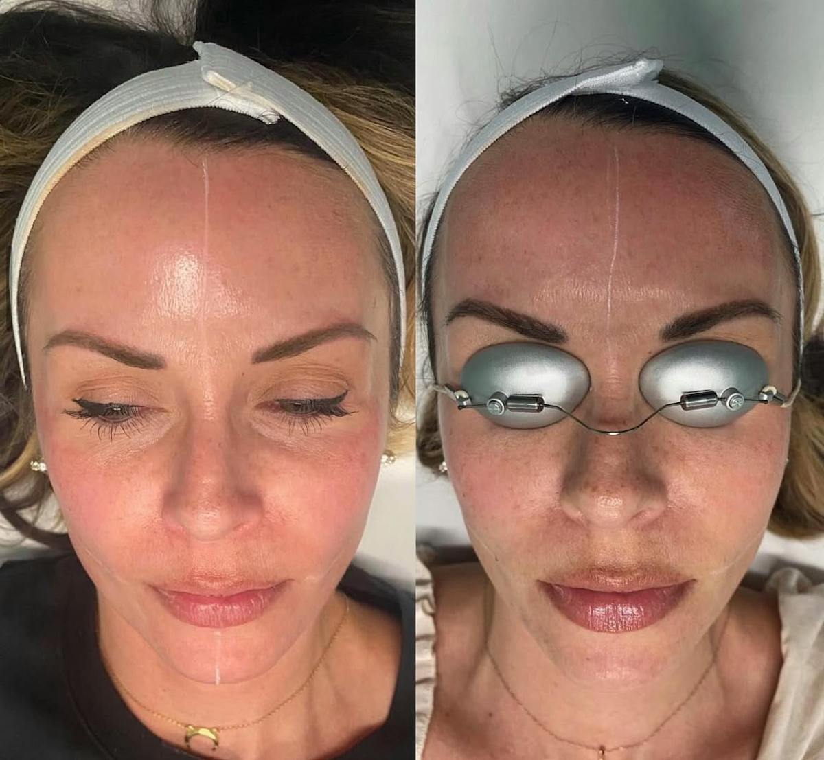 PicoSure Rejuvenation Before & After Gallery - Patient 177711 - Image 1