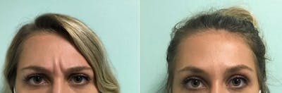 Neurotoxin Before & After Gallery - Patient 298074 - Image 1