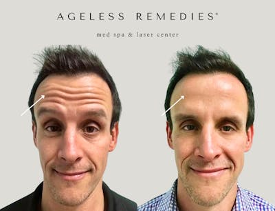 Neurotoxin Before & After Gallery - Patient 272624 - Image 1