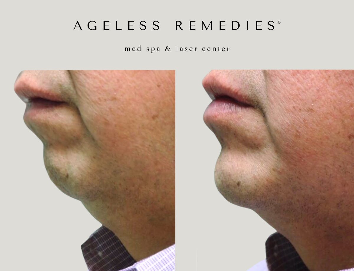 Chin Before & After Gallery - Patient 107096 - Image 1