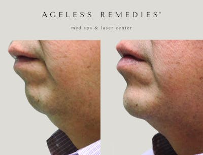 Chin Before & After Gallery - Patient 107096 - Image 1