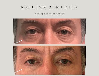 Undereye Before & After Gallery - Patient 323640 - Image 1