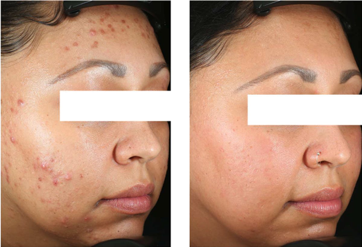 Accure Acne Treatment Before & After Gallery - Patient 243375 - Image 1