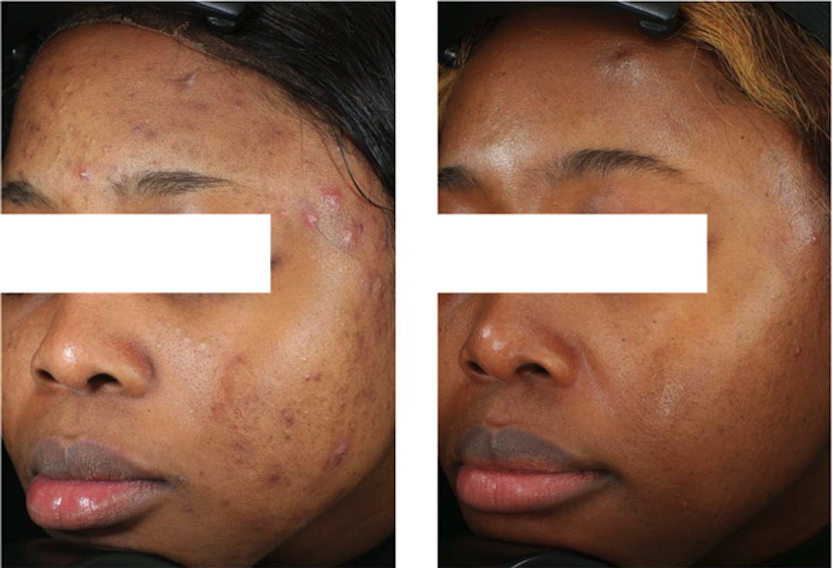 Accure Acne Treatment Before & After Gallery - Patient 454998 - Image 1
