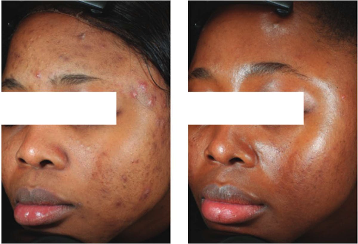 Accure Acne Treatment Before & After Gallery - Patient 454998 - Image 2