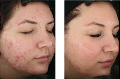 Accure Acne Treatment Before & After Gallery - Patient 279760 - Image 1