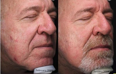 Accure Acne Treatment Before & After Gallery - Patient 107125 - Image 1