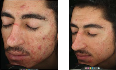 Accure Acne Treatment Before & After Gallery - Patient 383837 - Image 1