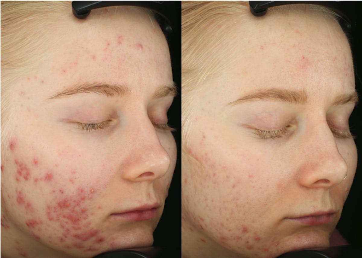 Accure Acne Treatment Before & After Gallery - Patient 207987 - Image 1