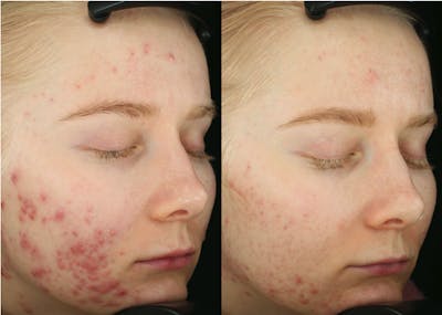 Accure Acne Treatment Before & After Gallery - Patient 207987 - Image 1