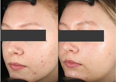 Accure Acne Treatment Before & After Gallery - Patient 976767 - Image 1