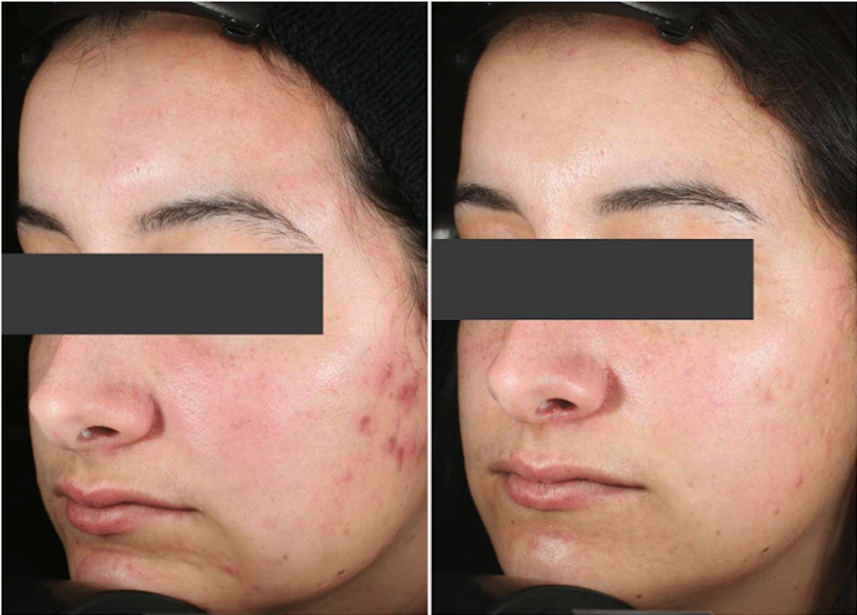 Accure Acne Treatment Before & After Gallery - Patient 284896 - Image 1