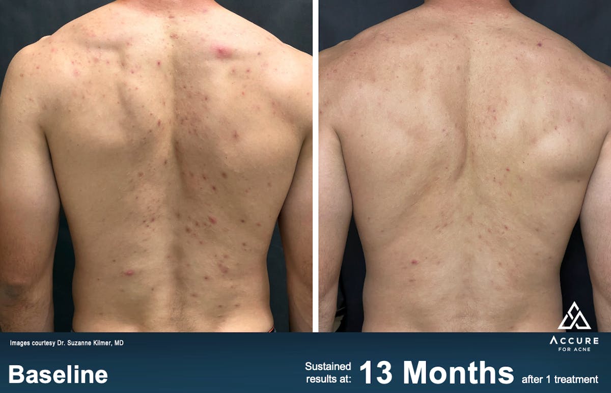 Accure Acne Treatment Before & After Gallery - Patient 423994 - Image 1