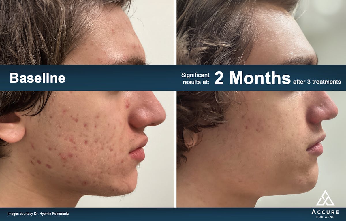 Accure Acne Treatment Before & After Gallery - Patient 380832 - Image 1