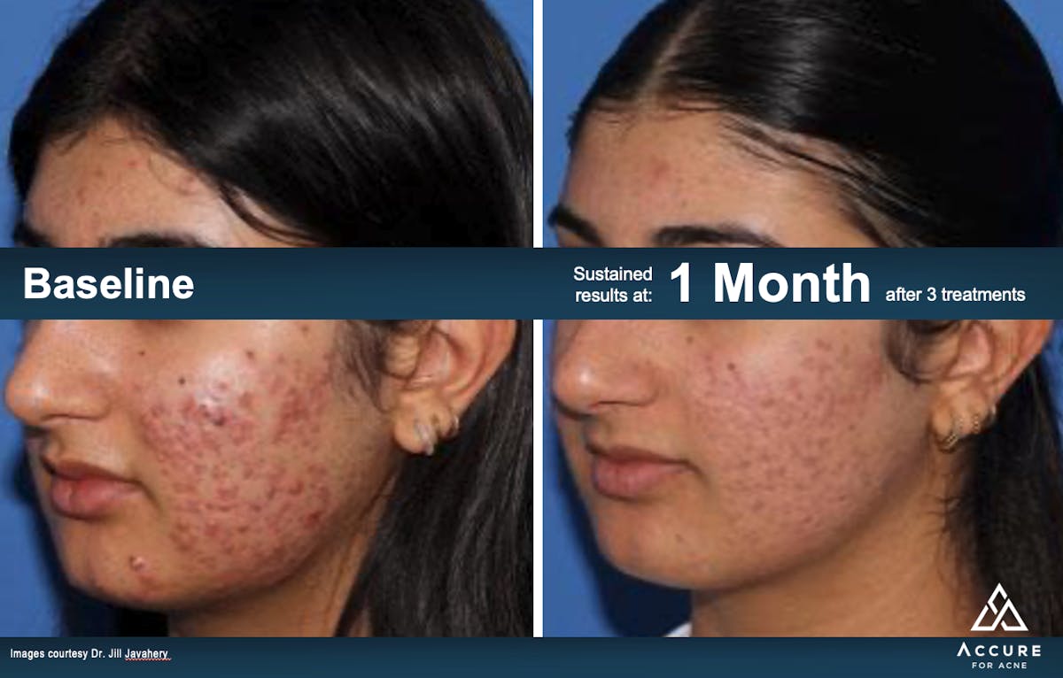 Accure Acne Treatment Before & After Gallery - Patient 115228 - Image 1