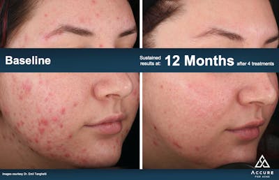 Accure Acne Treatment Before & After Gallery - Patient 807996 - Image 1