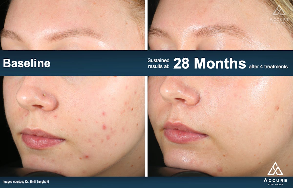 Accure Acne Treatment Before & After Gallery - Patient 220355 - Image 1