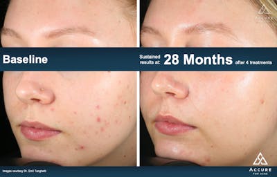 Accure Acne Treatment Before & After Gallery - Patient 220355 - Image 1
