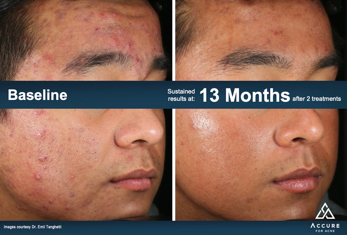 Accure Acne Treatment Before & After Gallery - Patient 242887 - Image 1