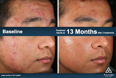 Accure Acne Treatment Before & After Gallery - Patient 242887 - Image 1