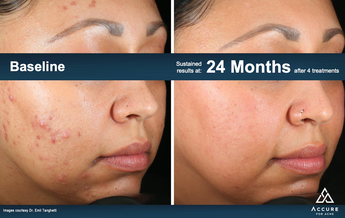 Accure Acne Treatment Before & After Gallery - Patient 503877 - Image 1