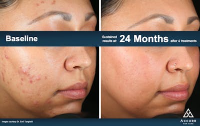 Accure Acne Treatment Before & After Gallery - Patient 503877 - Image 1