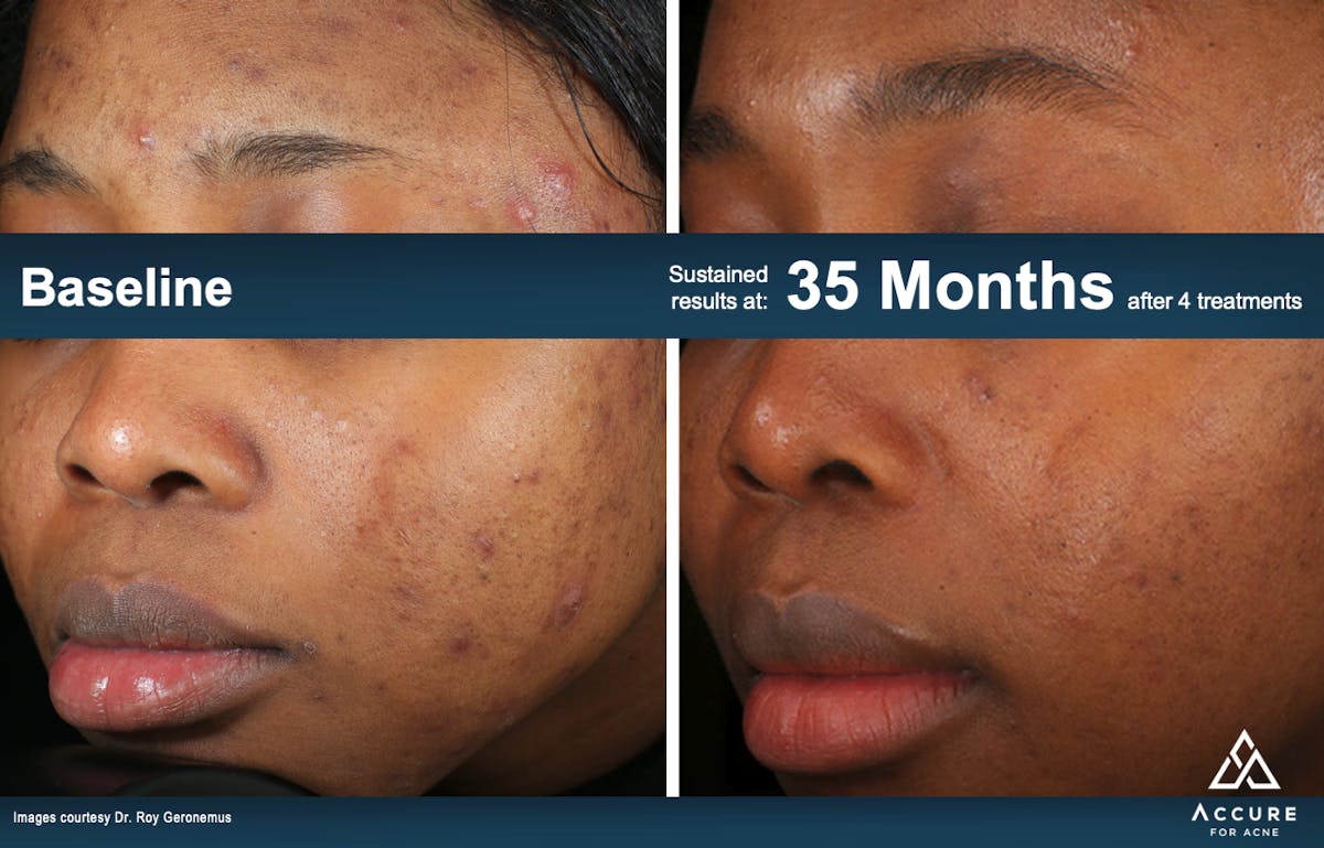 Accure Acne Treatment Before & After Gallery - Patient 178825 - Image 1