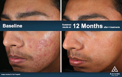 Accure Acne Treatment Before & After Gallery - Patient 351913 - Image 1