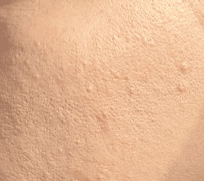 Microneedling Before & After Gallery - Patient 167725 - Image 1