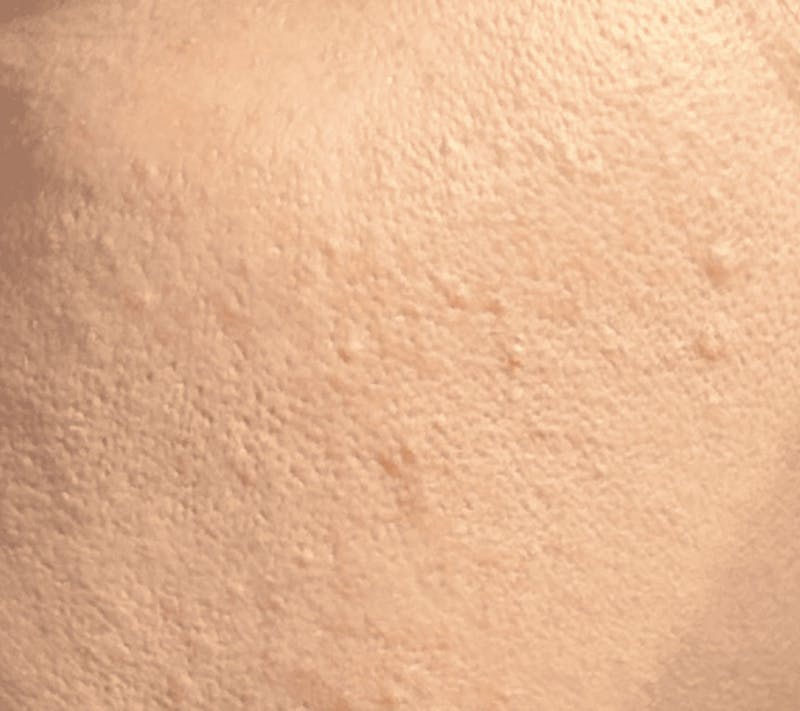Microneedling Before & After Gallery - Patient 167725 - Image 1