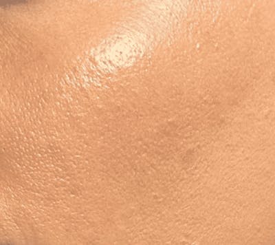 Microneedling Before & After Gallery - Patient 167725 - Image 2