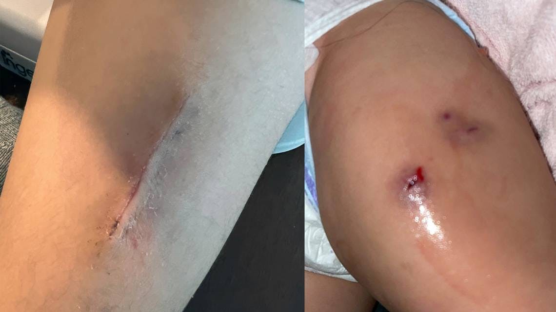 Miami kids needed surgery after infections set in. Were contaminated needles to blame?
