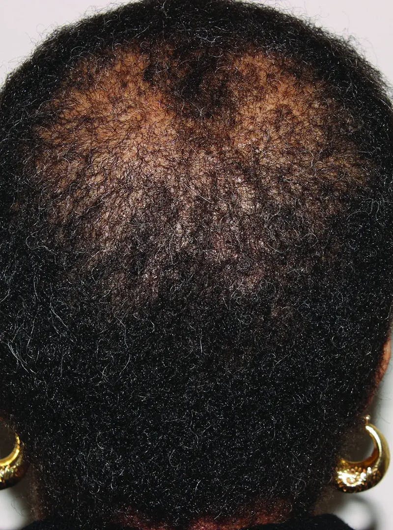 Low Level Laser Therapy Before & After Gallery - Patient 355979 - Image 1