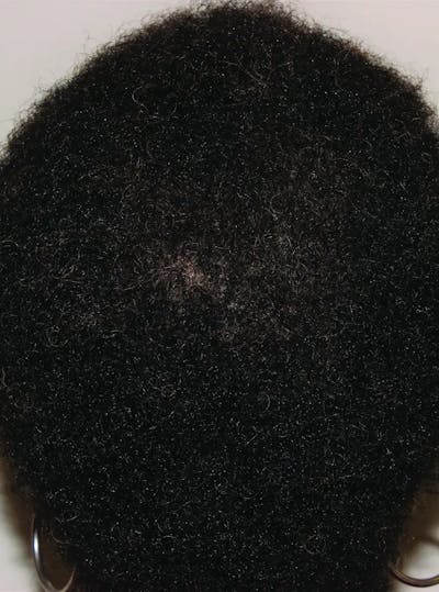 Low Level Laser Therapy Before & After Gallery - Patient 355979 - Image 2