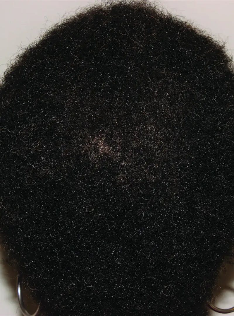 Low Level Laser Therapy Before & After Gallery - Patient 355979 - Image 2