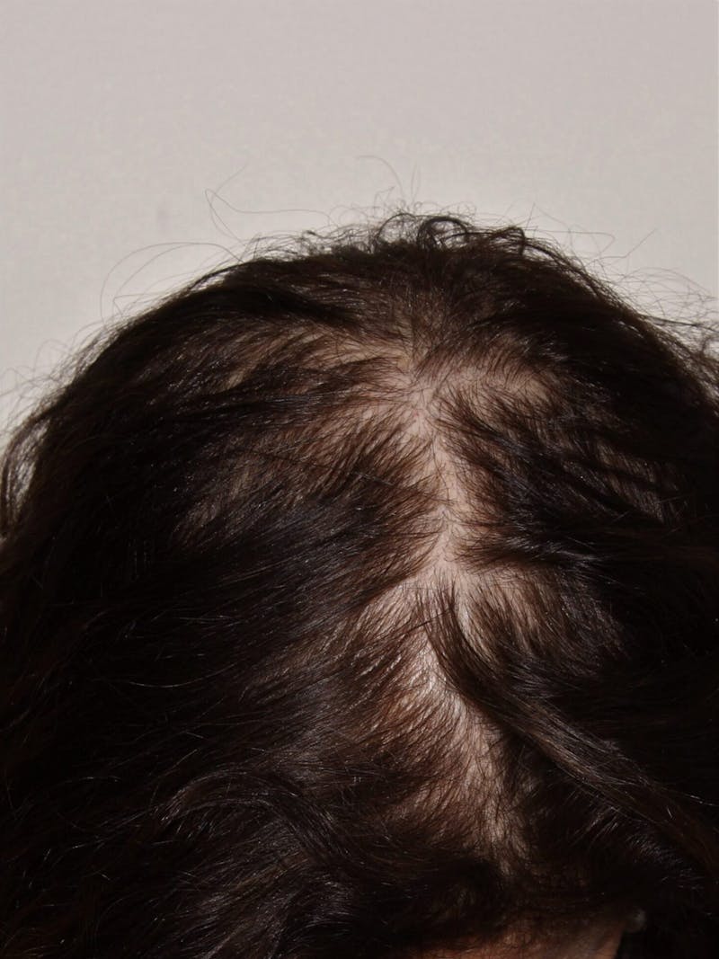 Low Level Laser Therapy Before & After Gallery - Patient 276788 - Image 1
