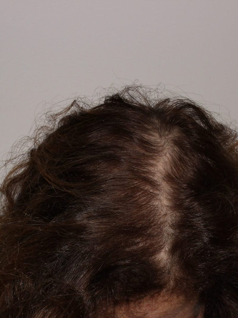 Low Level Laser Therapy Before & After Gallery - Patient 276788 - Image 2
