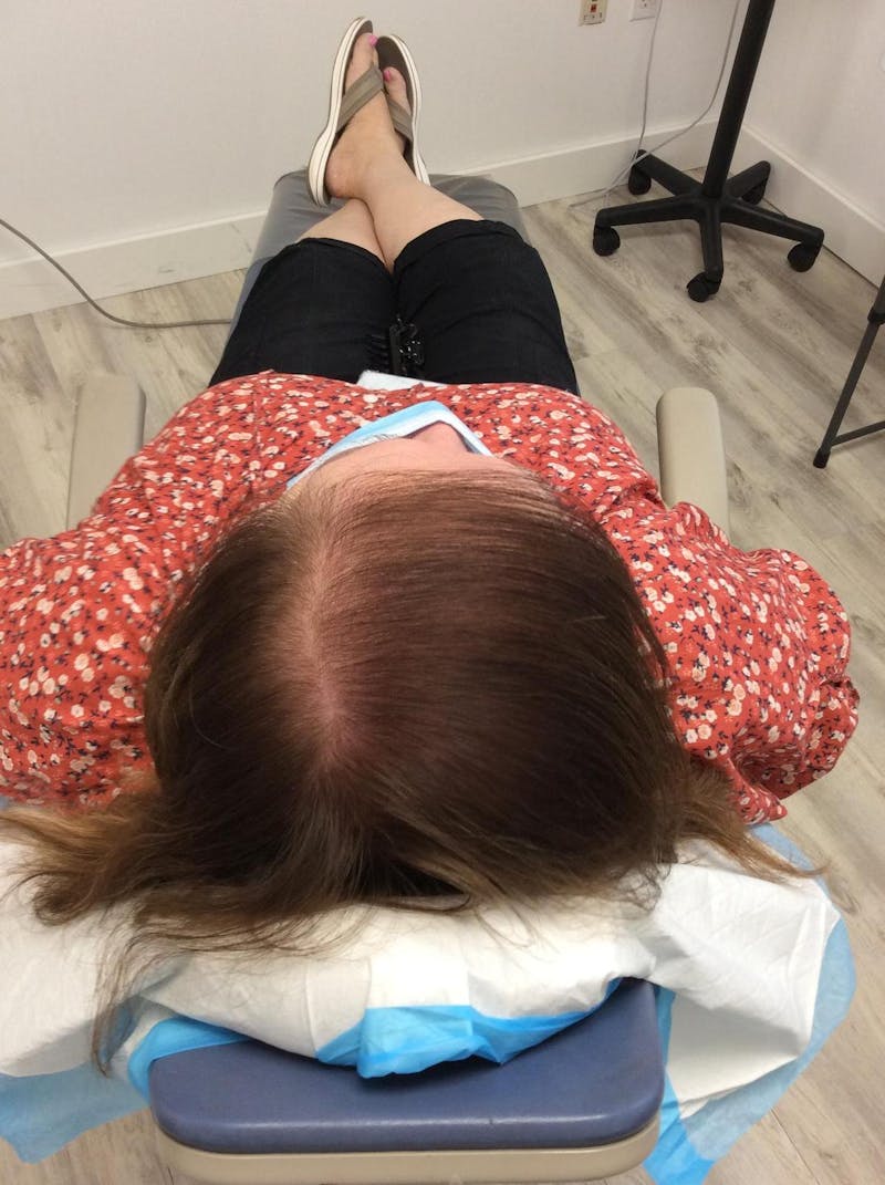 Optimal Platelet Concentration™ Therapy Before & After Gallery - Patient 412232 - Image 2