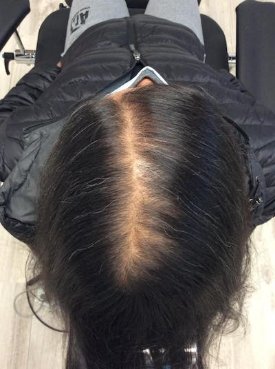 Optimal Platelet Concentration™ Therapy Before & After Gallery - Patient 276846 - Image 1