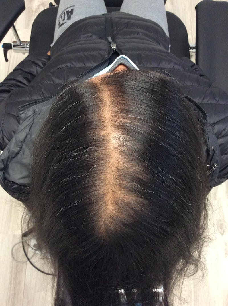 Optimal Platelet Concentration™ Therapy Before & After Gallery - Patient 276846 - Image 1