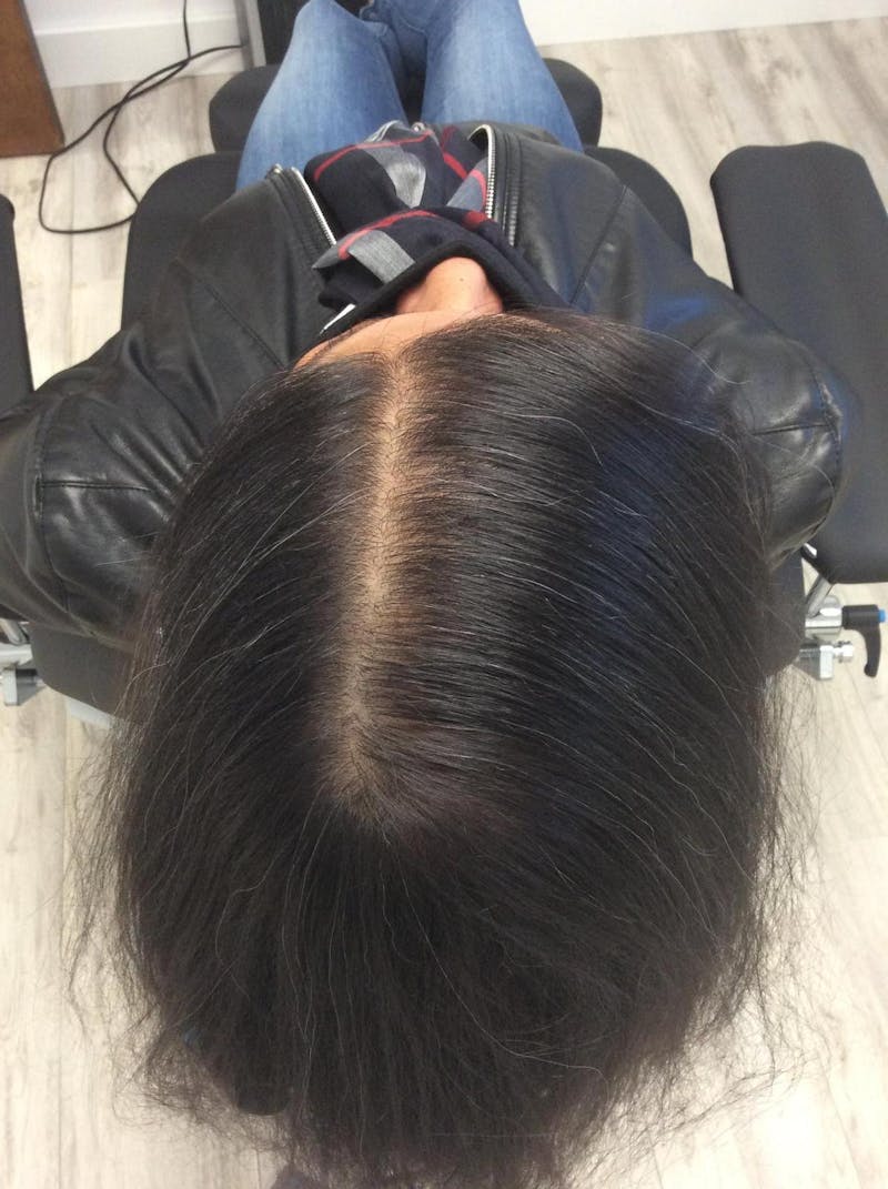 Optimal Platelet Concentration™ Therapy Before & After Gallery - Patient 276846 - Image 2