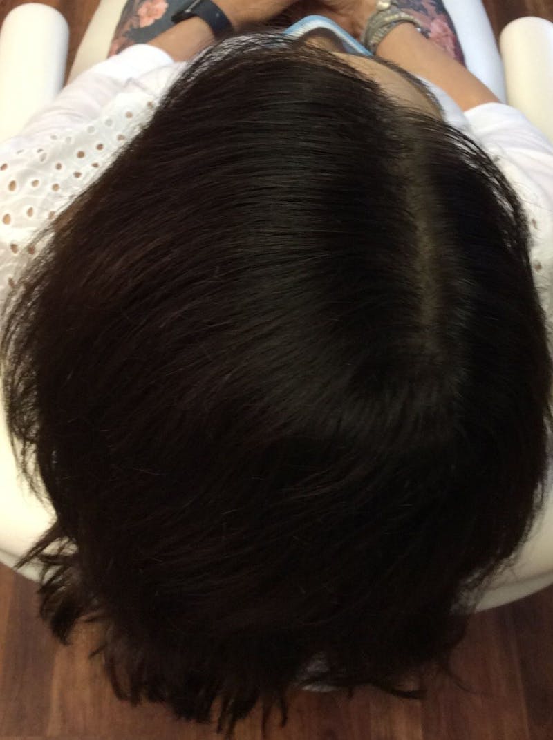 Platelet Rich Plasma Therapy Before & After Gallery - Patient 239213 - Image 2
