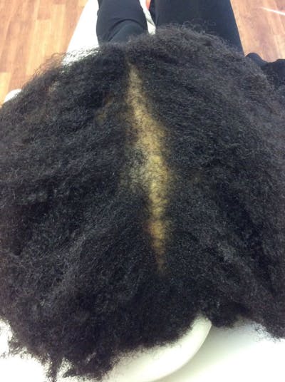 Platelet Rich Plasma Therapy Before & After Gallery - Patient 272386 - Image 2