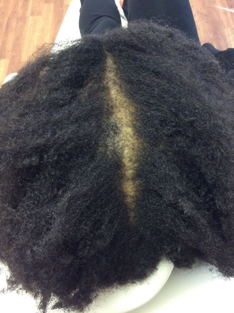 Platelet Rich Plasma Therapy Before & After Gallery - Patient 272386 - Image 2